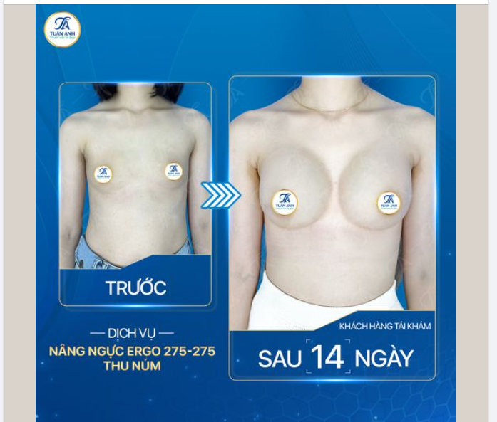 Tiếp tục 1 ca siêu phẩm nâng ngực túi Egro 14 ngày tuổi tại Thẩm mỹ Tuấn Anh