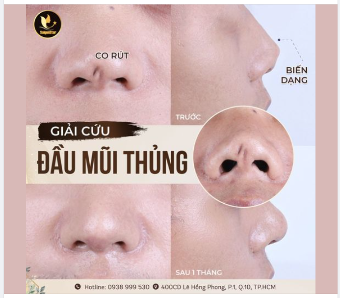 HÀNH TRÌNH SỬA MŨI LẦN 4 CỦA NAM KHÁCH HÀNG ĐẾN TỪ HÀ NỘI
