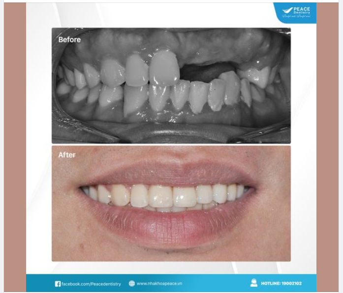 CA LÂM SÀNG IMPLANT CÓ GHÉP XƯƠNG GHÉP MÔ LIÊN KẾT