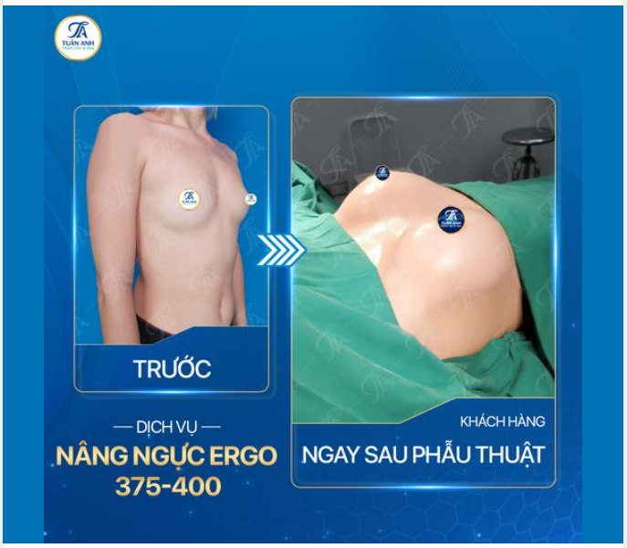 Chị em đặt lịch nâng ngực gần như kín chỗ, chỉ còn một vài khung giờ trống. Vậy nâng ngực tại nhà Tuấn Anh có gì mà lại hot như vậy: