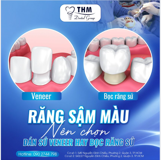 RĂNG SẬM MÀU NÊN CHỌN DÁN SỨ VENEER HAY BỌC SỨ?