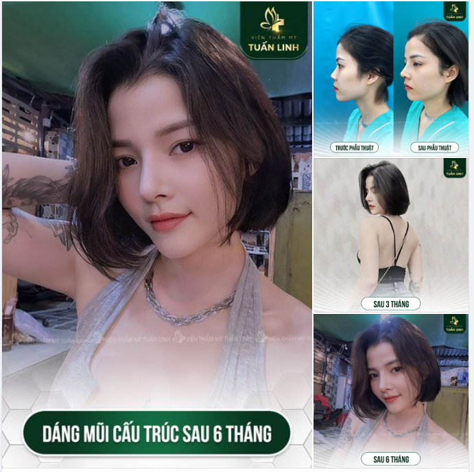 Dáng mũi Angel line cao tây pha chút tự nhiên luôn là sự lựa chọn cho các cô nàng cá tính, năng động, trẻ trung.