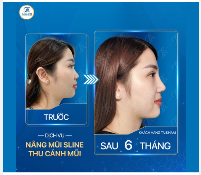 Mũi ngắn, tẹt khiến ngũ quan của chị khách hàng không hài hòa. Sau khi được bác sĩ tư vấn thì chị quyết định nâng mũi Sline kết hợp thu cánh mũi.