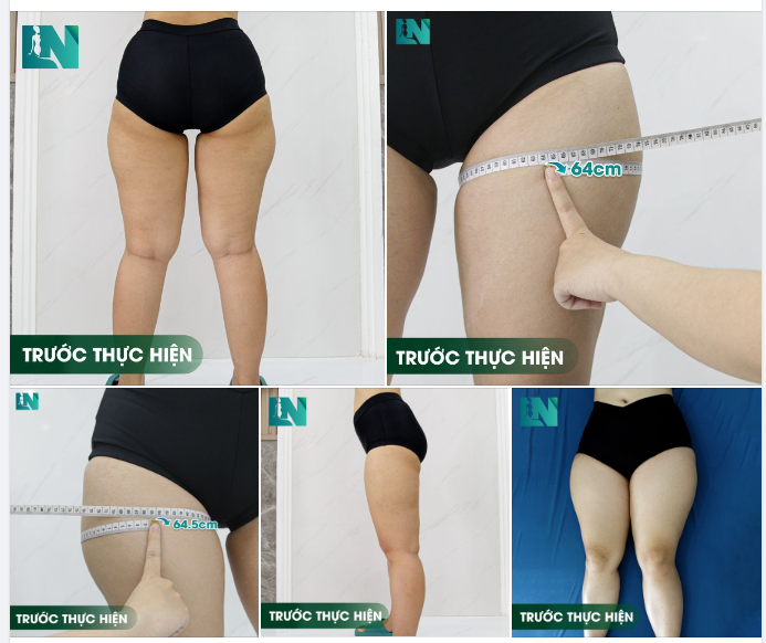 HÚT MỠ TẠO DÁNG VÙNG ĐÙI - TRẢ LẠI DÁNG VÓC THON GỌN CHO CHỊ KHÁCH 9X