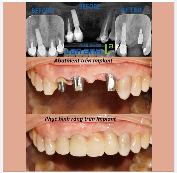 Trồng răng implant - Hoàn thiện nụ cười