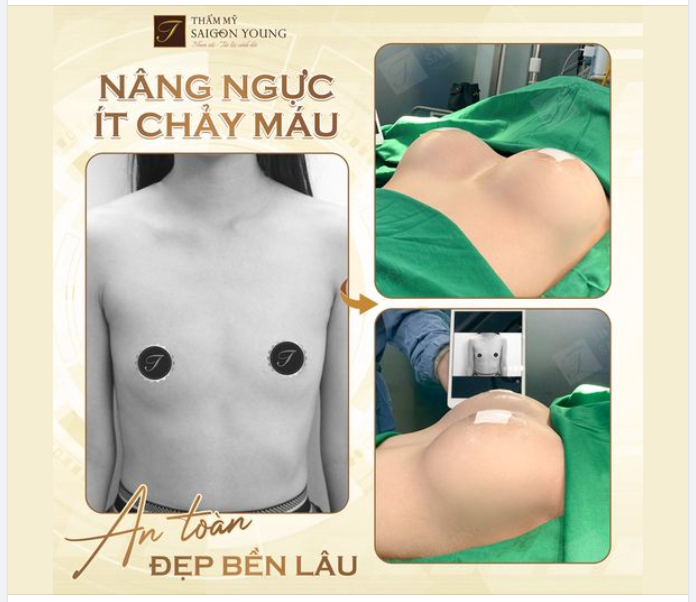 NÂNG NGỰC ÍT CHẢY MÁU - ÍT XÂM LẤN. Và những lợi ích khi thực hiện.