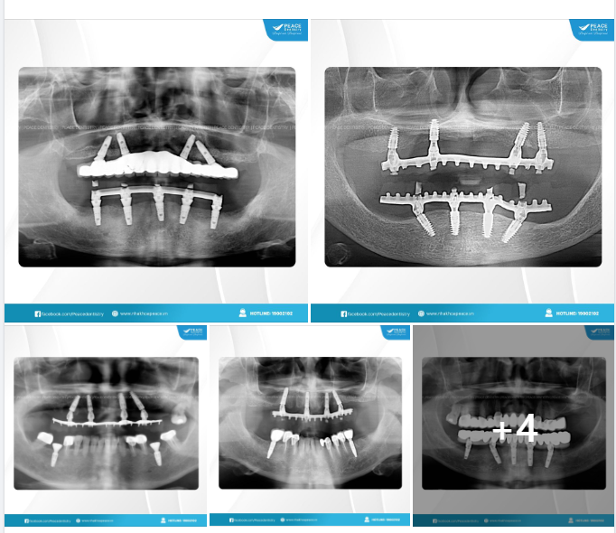 Lý do vì sao mà All-on-4 (trồng răng Implant toàn hàm) có thể tiến hành phục hình tức thì hoàn thành trong 14 ngày?