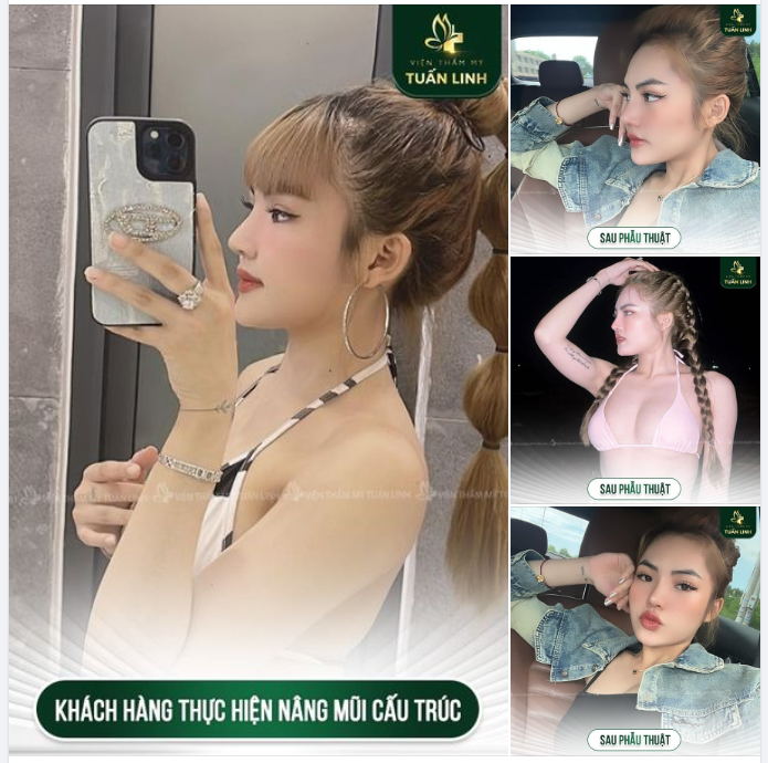 Click xem từng hình, ngắm chiếc mũi cao xinh của khách hàng sau khi nâng mũi tại Tuấn Linh - 100% người thật, việc thật.