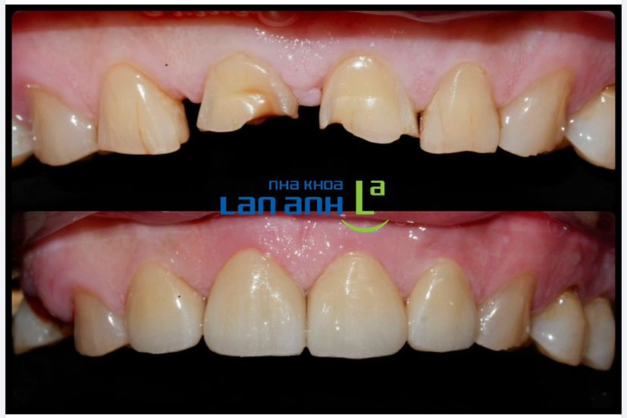 Phục hồi răng sứ Cercon cho răng mòn nhiều