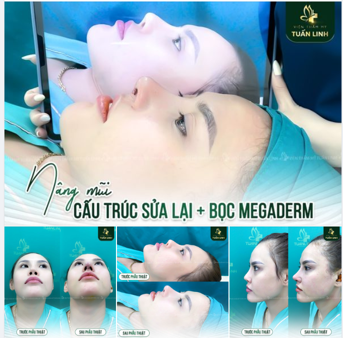 Sau 120 phút phẫu thuật, bác sĩ đã loại bỏ hoàn toàn tình trạng bao xơ, co rút sụn, dáng mũi đơ thô nhiều.
