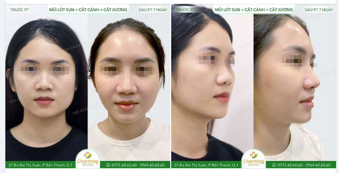 Mũi thấp những không có quá nhiều khuyết điểm... à thật ra là có nhưng vẫn có thể cải thiện bằng những phẫu thuật khác song song.