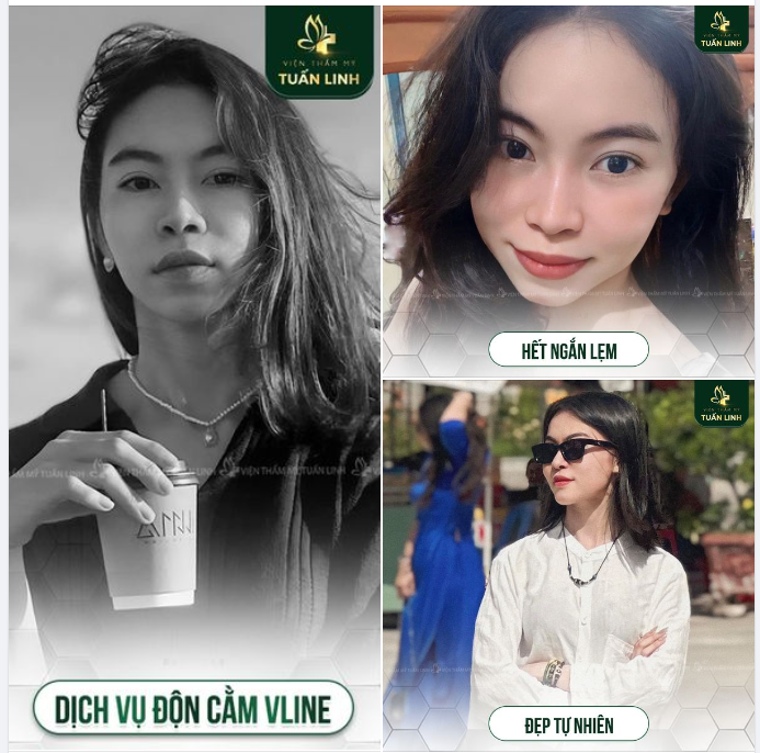ĐỘN CẰM VLINE - HẾT NGẮN LẸM CẰM ĐẸP TỰ NHIÊN!!