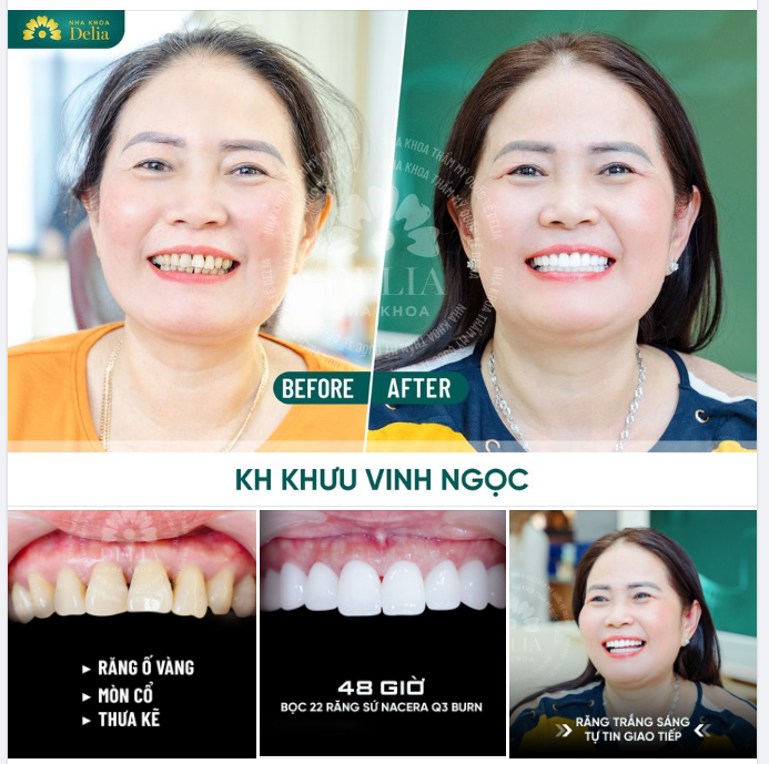 KIẾN TẠO NỤ CƯỜI TRẮNG SÁNG, TỰ TIN CHỈ SAU 48H