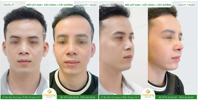 Mới sau phẫu thuật 7 ngày thôi nhưng mà chiếc mũi lót sụn + cắt cánh + cắt xương đã mang đến một độ cao và tỉ lệ mũi trông mê hồn