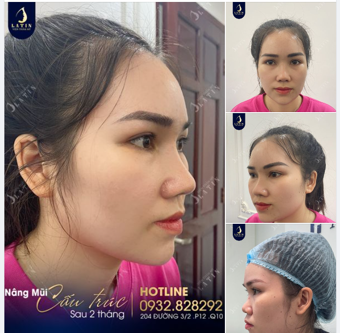 "Bao nhiêu năm sống với mũi tẹt, nhờ Latin mà em tự tin hơn rất nhiều..."