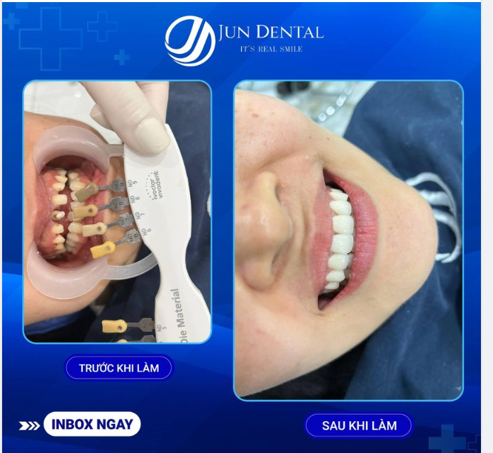ĐIỀU TRỊ NỘI NHA THẤT BẠI - GIẢI PHÁP NÀO DÀNH CHO BẠN?
