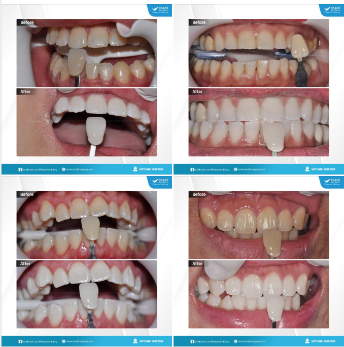 CHỈ VỚI 2 GIỜ tại Peace Dentistry, bạn sẽ có một nụ cười khác: trắng sáng hơn, rạng rỡ cuốn hút hơn và biến mọi khoảnh khắc đều trở nên quý giá!