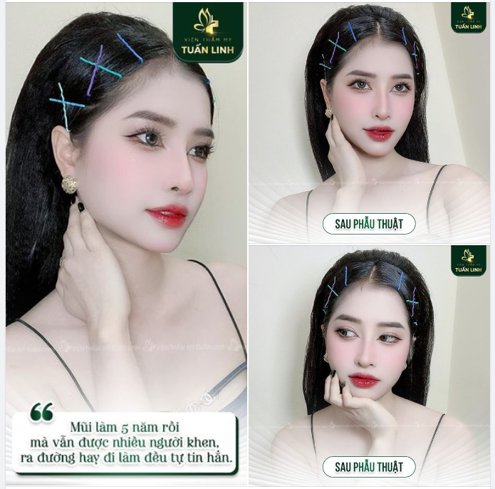Tâm sự nhỏ của khách hàng sau 5 năm nâng mũi