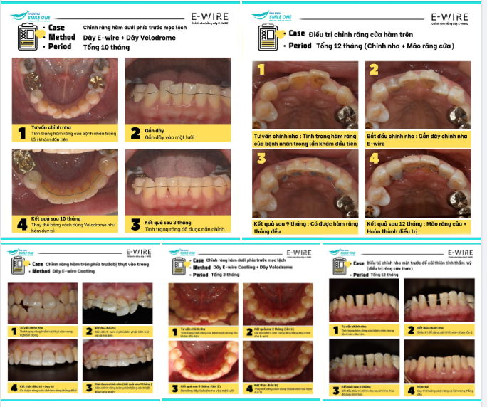 Hãy xem những hình ảnh dưới đây để hiểu rõ hơn về phương pháp niềng răng không mắc cài này nhé!