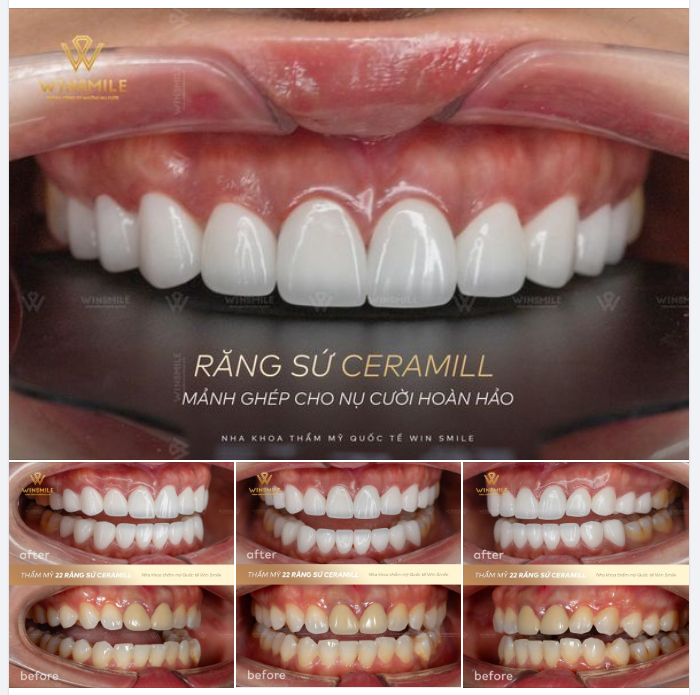 RĂNG SỨ CERAMILL - MẢNH GHÉP CHO NỤ CƯỜI HOÀN HẢO