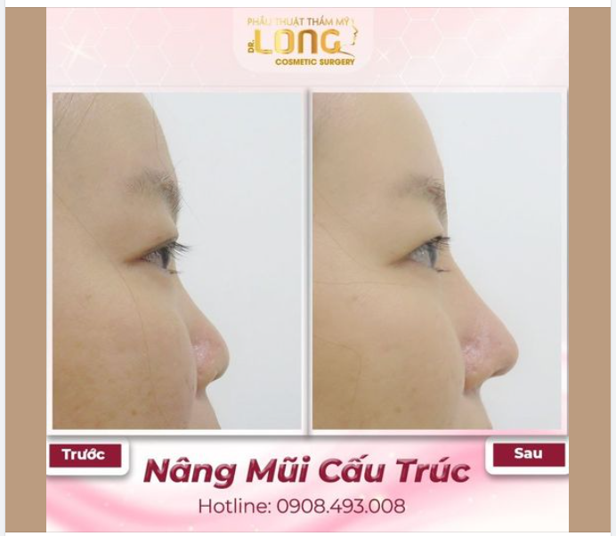 NÂNG MŨI CẤU TRÚC - Phương pháp dành riêng cho những chiếc mũi "nhiều khuyết điểm"