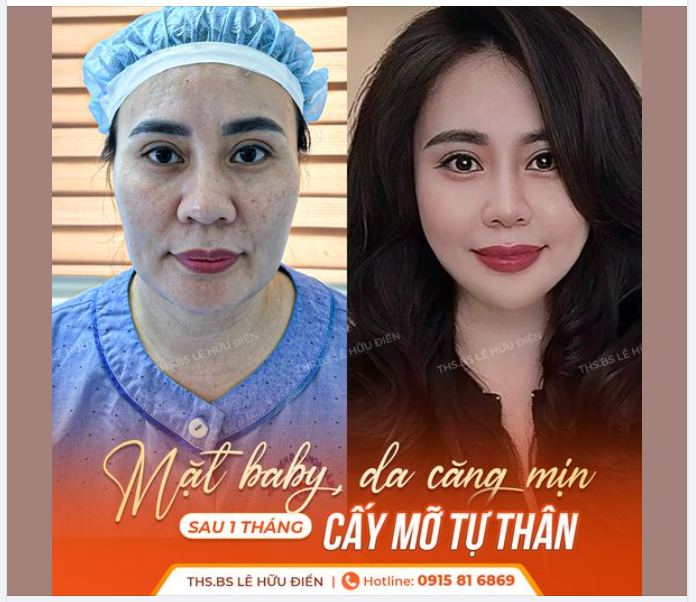 MẶT BABY - DA CĂNG MỊN SAU 1 THÁNG CẤY MỠ TỰ THÂN
