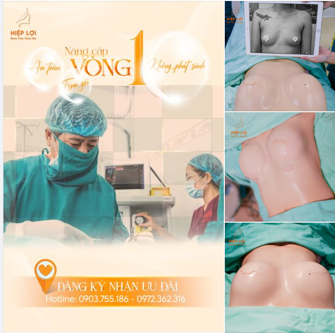 NÂNG CẤP VÒNG 1 - CÙNG DÒNG TÚI NGỰC CAO CẤP
