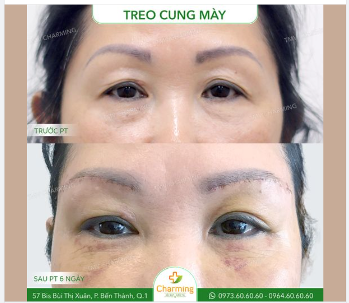 "Một mũi tên trúng hai con nhạn" là một câu nói Charming thường gắn với phương pháp treo cung mày. Mọi người có biết vì sao không?