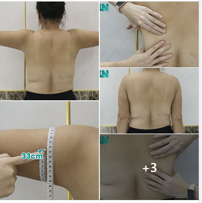 COMBO HÚT MỠ TAY LƯNG NÁCH - CẤY MỠ MÔNG CHO CHỊ KHÁCH VIỆT KIỀU