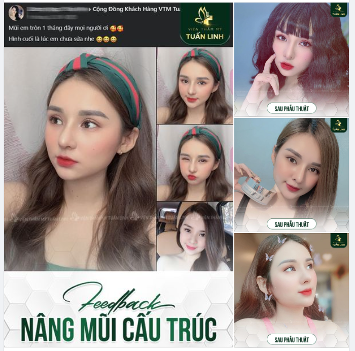 Chọn nơi Nâng Mũi uy tín nó quan trọng lắm nha chị em ơi.