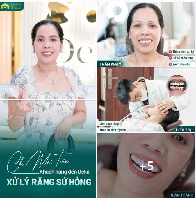 TẠM BIỆT RĂNG SỨ HỎNG - ĐÓN NỤ CƯỜI MỚI KHOẺ ĐẸP, TỰ TIN