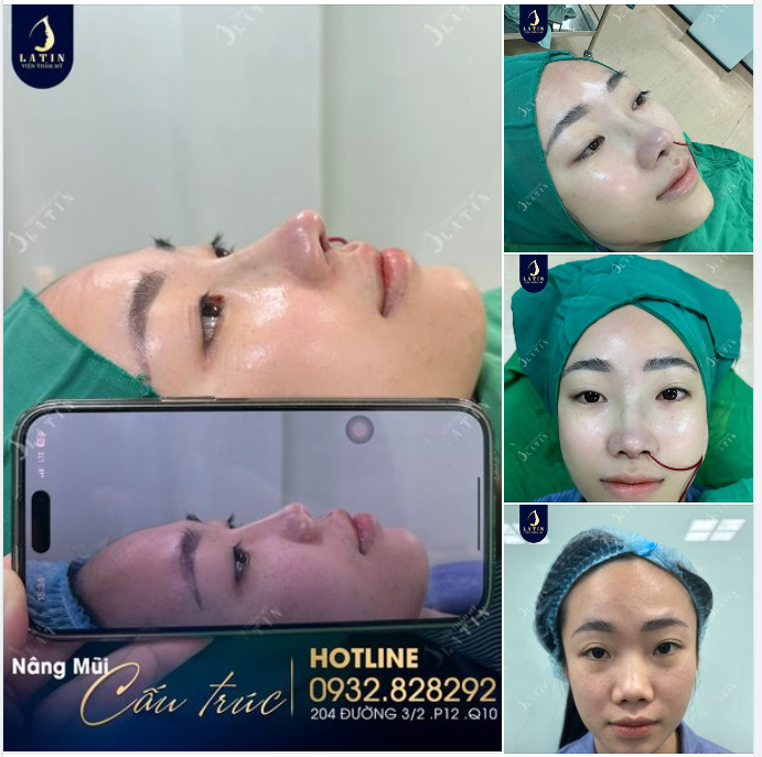 Ai rồi cũng phải "Nâng mũi" mà thôi!