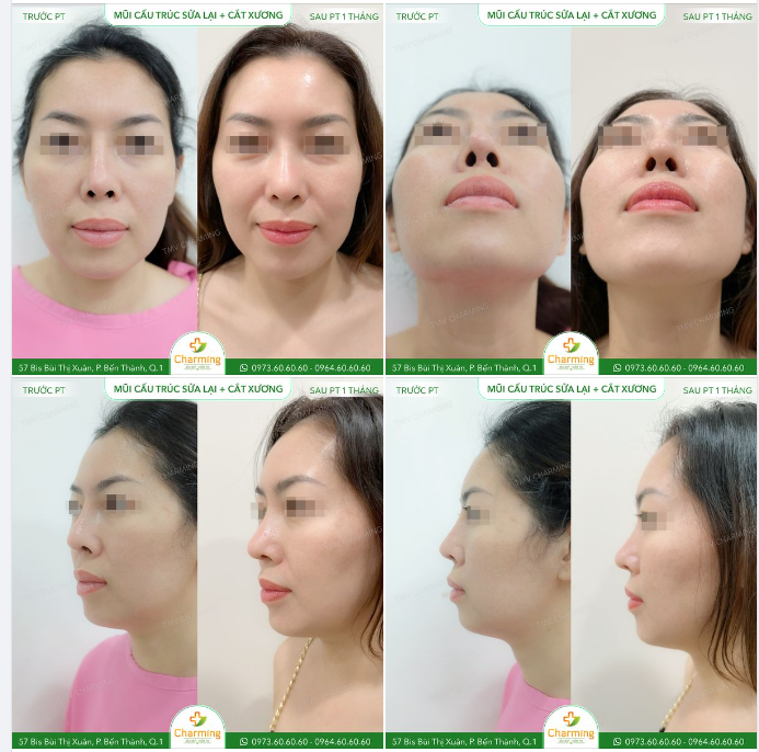 Mũi của bạn khách đã từng làm qua nhưng khổ thay, sóng mũi dù cao nhưng lại chẳng thẳng được như mong đợi.
