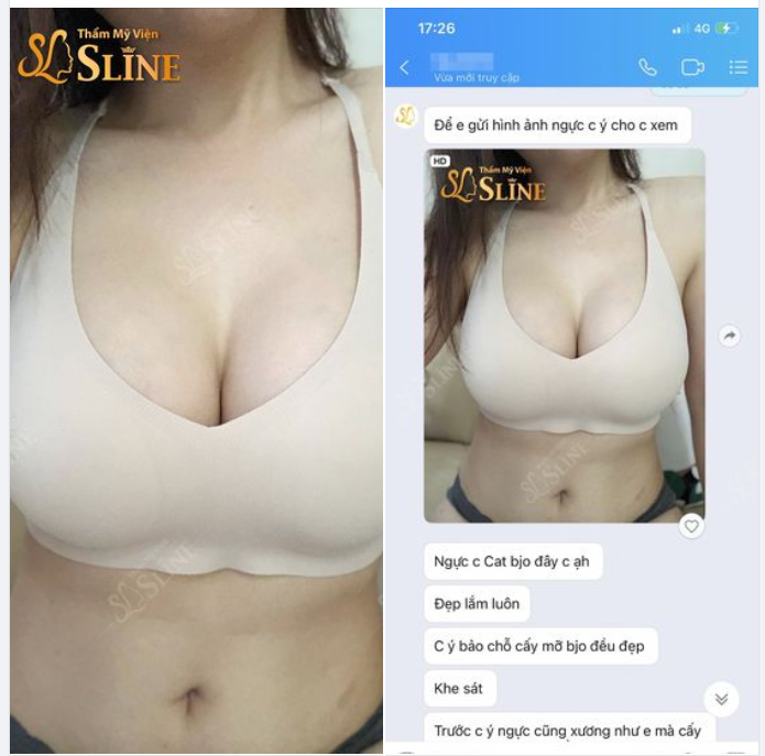 FEEDBACK THỰC TẾ 2 chị em lựa chọn Thẩm Mỹ Viện Sline để nâng cấp vòng 1