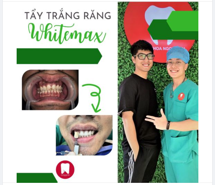 RĂNG Ố VÀNG DO HÚT THUỐC LÁ