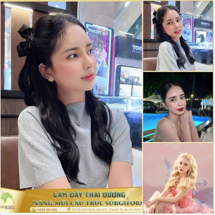 Nâng mũi cấu trúc Surgiform và Làm đầy thái dương - Tôn tạo nét đẹp nàng thơ, trẻ trung cho dung mạo quý Cô