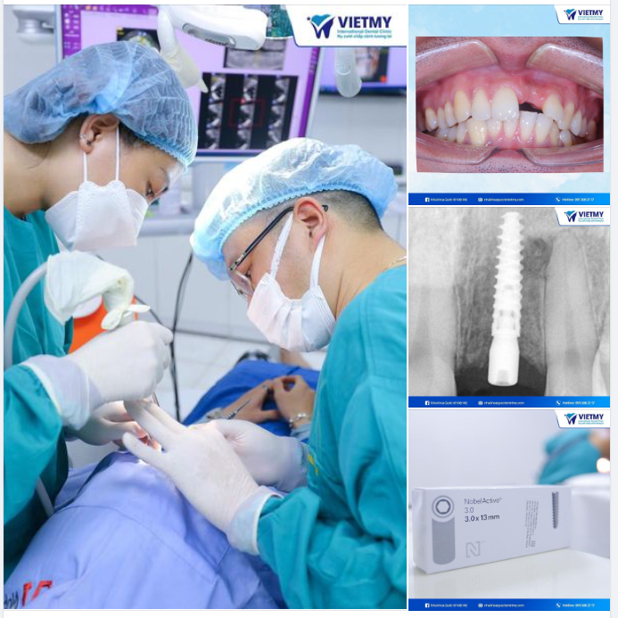 TIẾNG LÀNH ĐỒN XA  ĐÂY LÀ LÝ DO TẠI SAO KHÁCH HÀNG VIỆT KIỀU LUÔN TIN TƯỞNG CHỌN TRỒNG RĂNG TẠI NHA KHOA QUỐC TẾ VIỆT MỸ