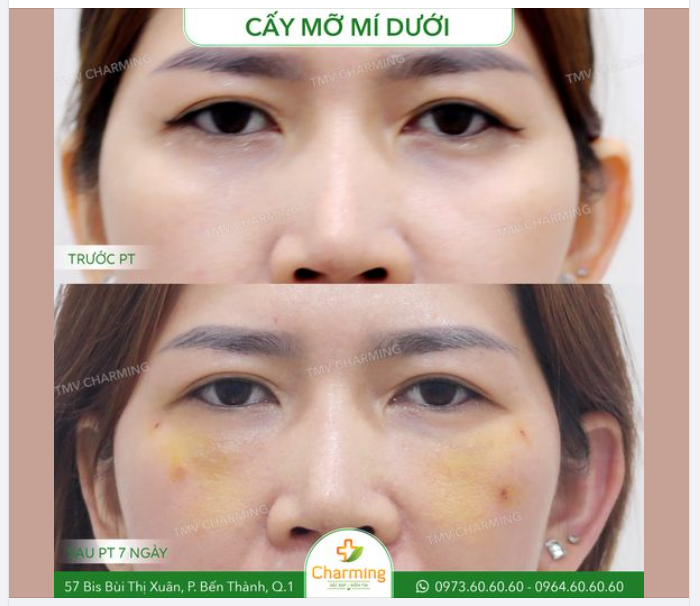 Mí dưới thiếu mỡ có thể khiến đôi mắt của bạn trông như thể hụt vào trong. Khuôn mặt cũng vì thế mà trở nên tăm tối, u hoài.