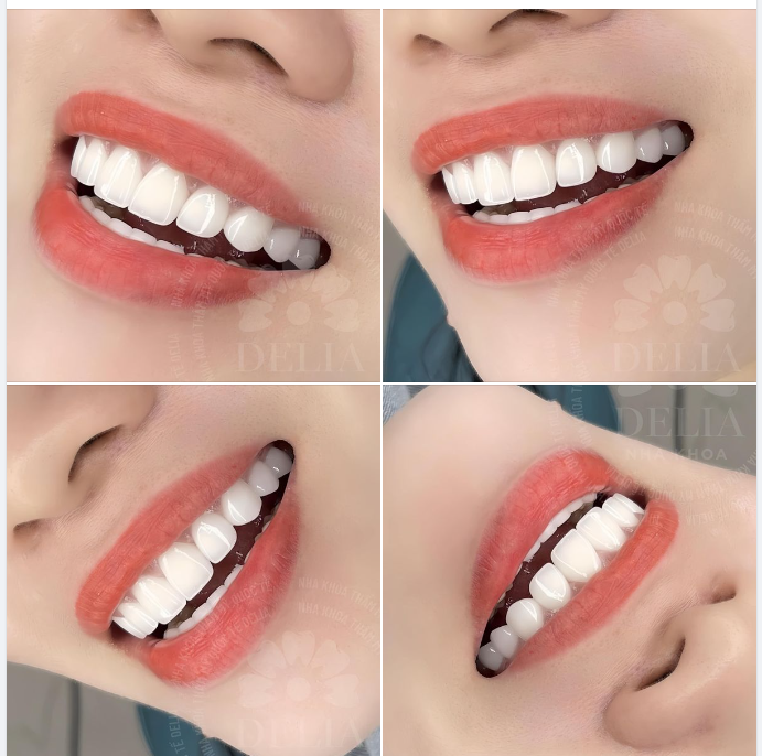 Delia bắt đầu ngày làm việc mới với 1 siêu phẩm răng sứ vừa mới hoàn thiện xong.