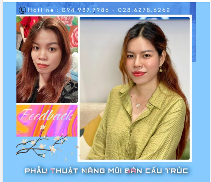 Không có một dáng mũi chuẩn cho tất cả mọi người mỗi sóng mũi đều được chúng tôi điêu khắc riêng cho phù hợp nhất voi gương mặt bạn, vừa cao đẹp vừa phải hài hoà.