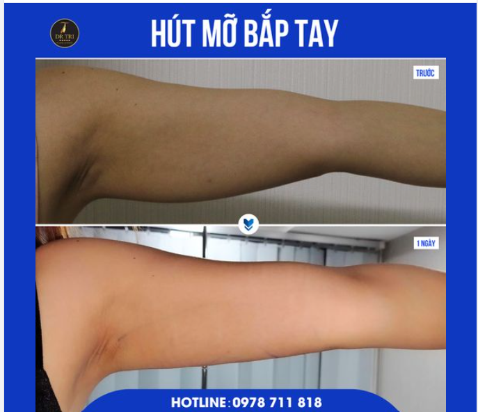 Loại bỏ 5-8cm MỠ THỪA - Thu gọn BẮP TAY- Chỉ trong 40 phút