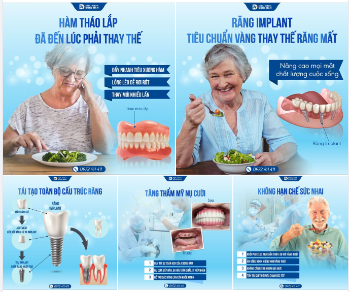 Chất lượng cuộc sống của răng Implant so với hàm giả tháo lắp thì không thể so sánh