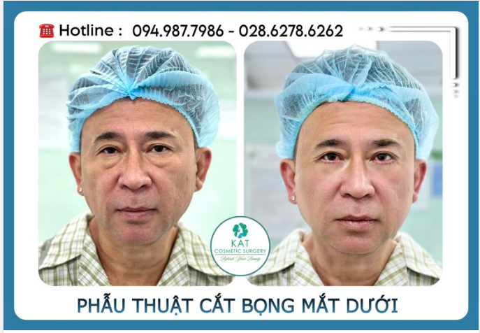 Hình chụp ngay sau phẫu thuật , không sưng bầm xíu nào đúng không cả nhà. Chưa cắt chỉ mà nhìn đã trẻ ra hơn 10 tuổi !