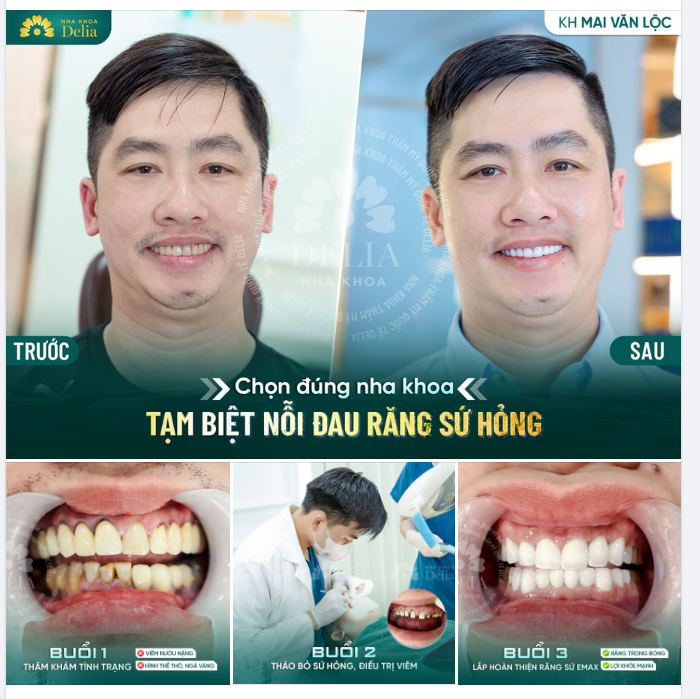 Từng bọc răng sứ tại nha khoa không uy tín, anh Mai Văn Lộc gặp nhiều bất tiện trong sinh hoạt hàng ngày