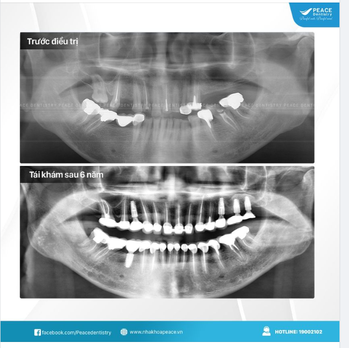  Tái khám Implant sau 6 năm và mọi thứ đều thật sự lý tưởng
