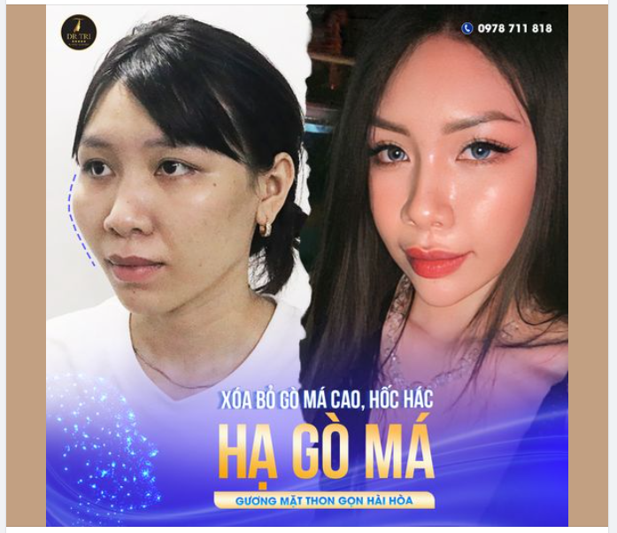 XÓA TAN MẶT BỰ NHỜ HẠ GÒ MÁ