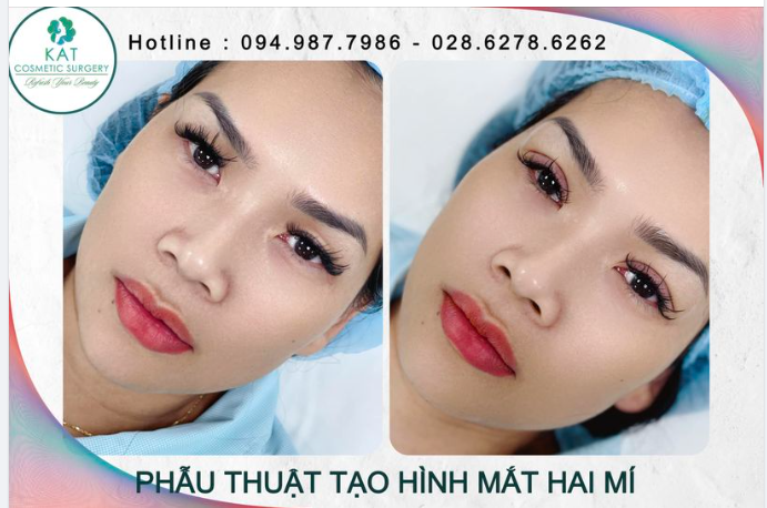 Chỉ với 15 phút, cải thiện ngay từ đôi mắt mí lót, nhỏ trở nên to tròn và long lanh hơn , tại sao không ​​​​​​​?