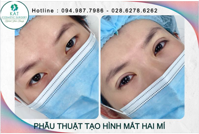 Chị đến tư vấn vì đôi mắt một bên sụp hoàn toàn không có nếp mí và 1 bên mi mắt lót, mí nhỏ gây ra tình trạng mắt hai bên hoàn toàn không đồng đều.