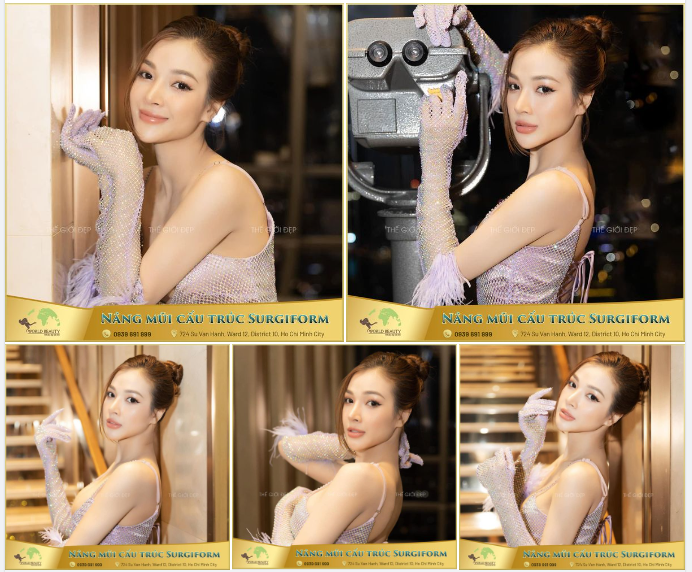 Mũi quý Cô đã từng n.âng cấu trúc sụn tai một lần nhưng khuyết điểm vẫn chưa được khắc phục.