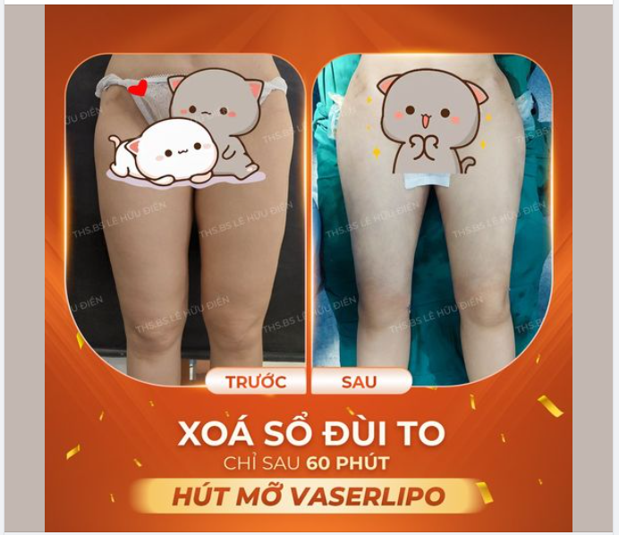 MỠ ĐÙI LÀ VÙNG KHÓ GIẢM NHẤT, PHẢI LÀM SAO?